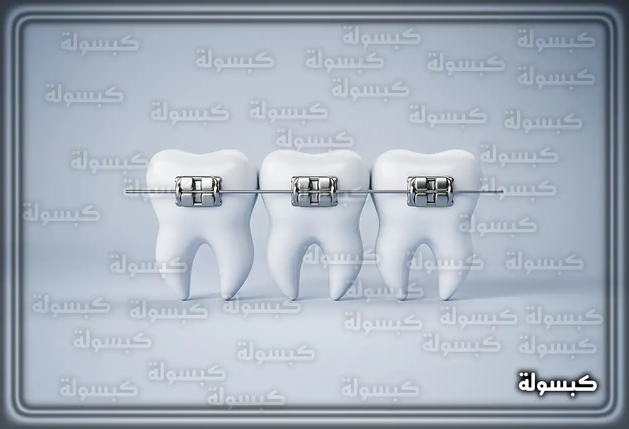 صورة توضيحية لأنواع تقويم الأسنان