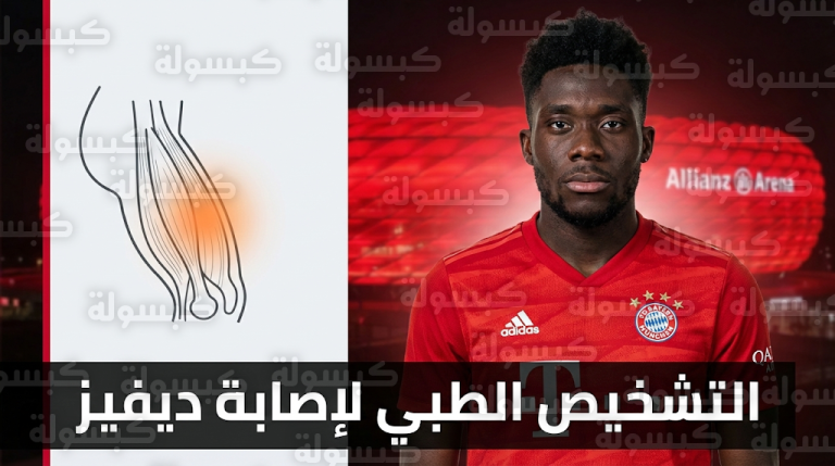 بيان رسمي من بايرن ميونخ يوضح طبيعة إصابة ألفونسو ديفيز والتشخيص الطبي